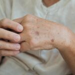 Les médecins expliquent les taches brunes sur les mains : pourquoi elles apparaissent et quand elles doivent inquiéter