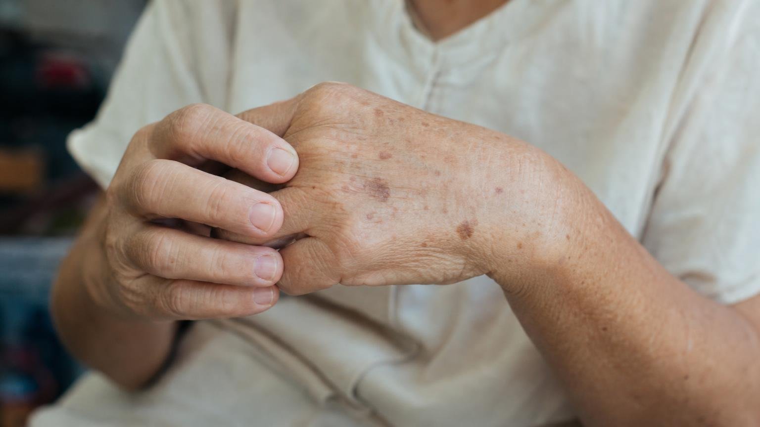 Les médecins expliquent les taches brunes sur les mains : pourquoi elles apparaissent et quand elles doivent inquiéter