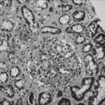 Pourquoi la C3G et la GNMP-CI primaire restent-elles difficiles à diagnostiquer ?