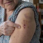 Pourquoi la peau des bras devient fine et se déchire au moindre choc après 70 ans : les dermatologues expliquent